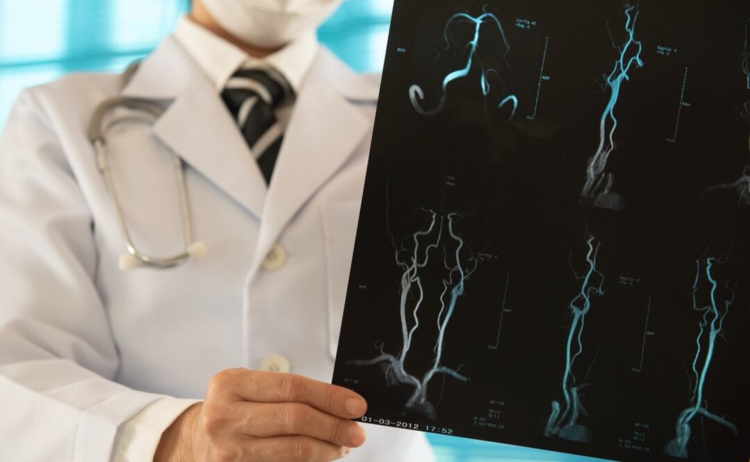 Estudio alerta que 10 millones de personas podrían morir por accidentes cerebrovasculares en 2050. Foto: iStock-utah778