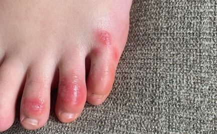 ¿Los moretones en los pies son un síntoma de Covid-19? Esto dicen los expertos