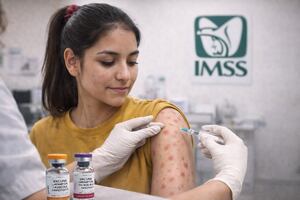 Sarampión en México: ¿La vacuna inmuniza o sólo reduce síntomas? Esto dicen expertos