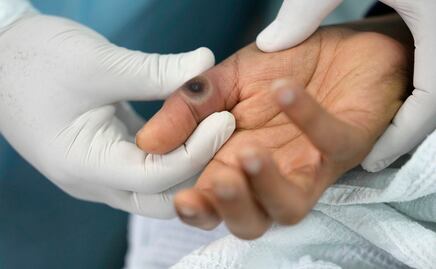 Viruela del mono. Suecia detecta primer caso de la variante más Infecciosa de Mpox