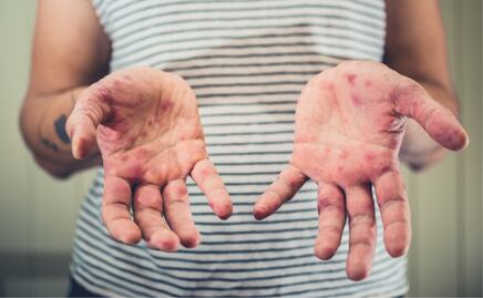 Alerta por sarampión en México. ¿Cuáles son los síntomas y las diferencias con la varicela? 