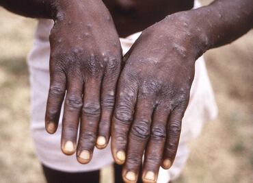 Viruela del mono. Urgen a países con reservas de vacunas Mpox a donar dosis a África