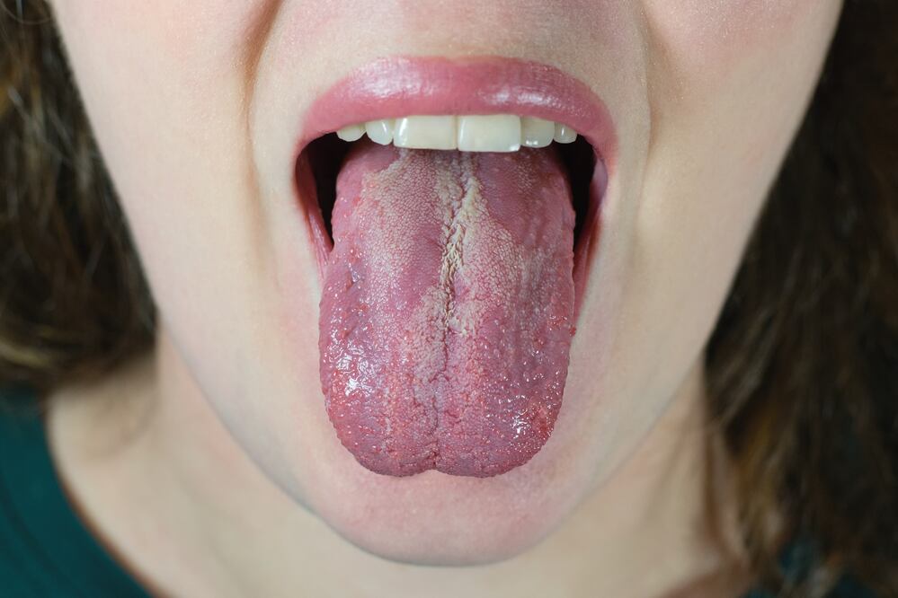 ¿Cuál es el color normal de la lengua? iStock/Tunatura