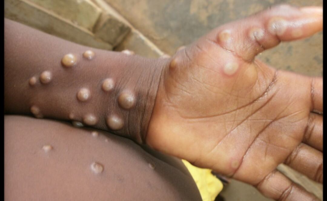 Foto: Nigeria Centre for Disease Control