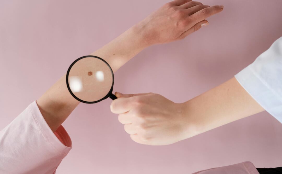 ¿Melanoma y cáncer de piel son lo mismo? Aprende a diferenciarlos y cómo prevenirlos FOTO: Pexels