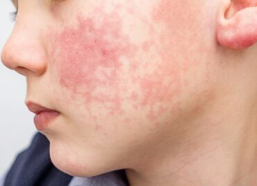 Aumentan casos del "Virus de la bofetada". Qué es, cómo se contagia y síntomas