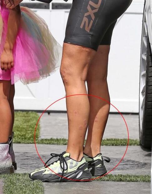 La batalla de Kim Kardashian contra la psoriasis se agudiza