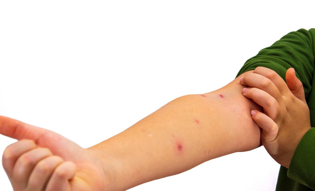 Estados Unidos registra 308 casos de sarampión en lo que va del año, supera el total de casos del 2024. Foto iStock / Aycan