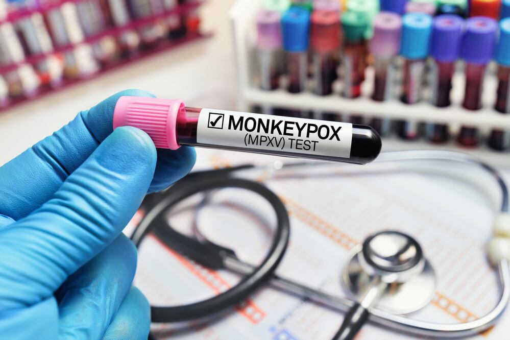 OMS alerta sobre nueva cepa mortal de mpox, viruela del mono. Foto iStock / angelp