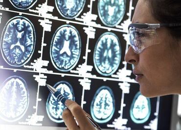 ¿El herpes labial puede causar alzhéimer? Esto dice un nuevo estudio