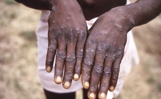 Viruela del mono. OMS sospecha de una “transmisión no detectada a tiempo”