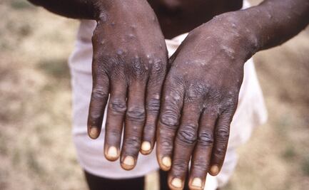 Suecia reporta el primer caso de la variante más peligrosa de la viruela del mono fuera de África